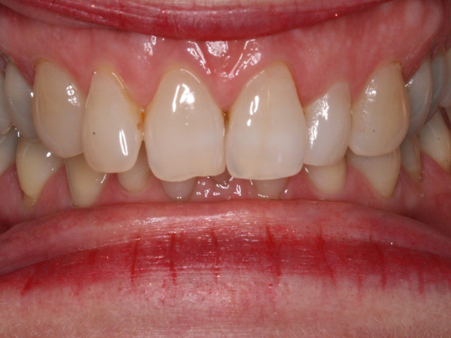 Before same-day restoration