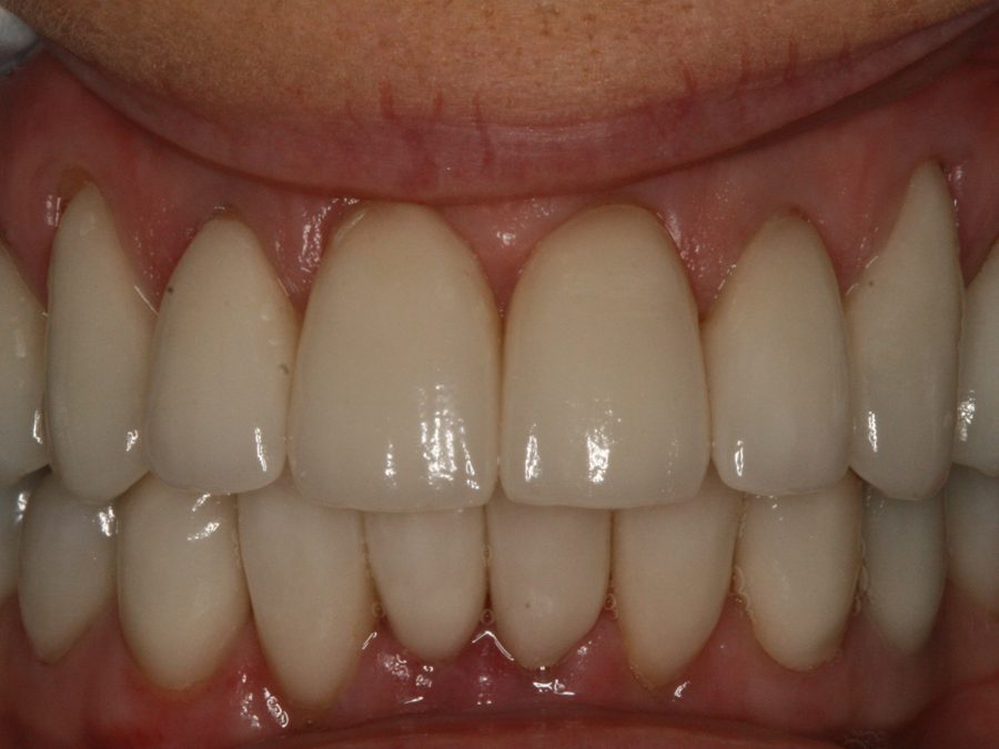 After same-day restoration