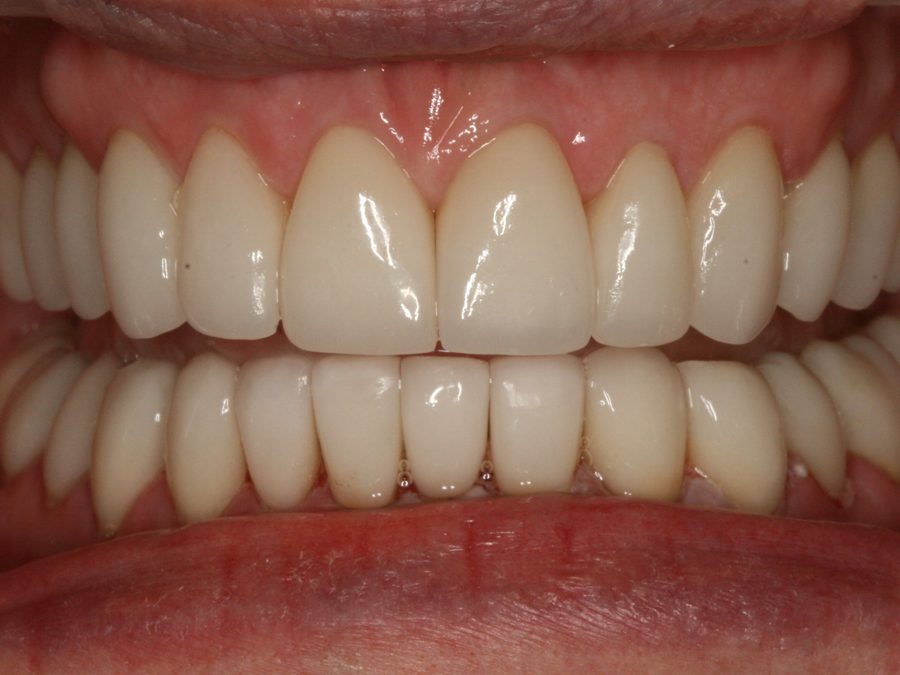 After same-day restoration