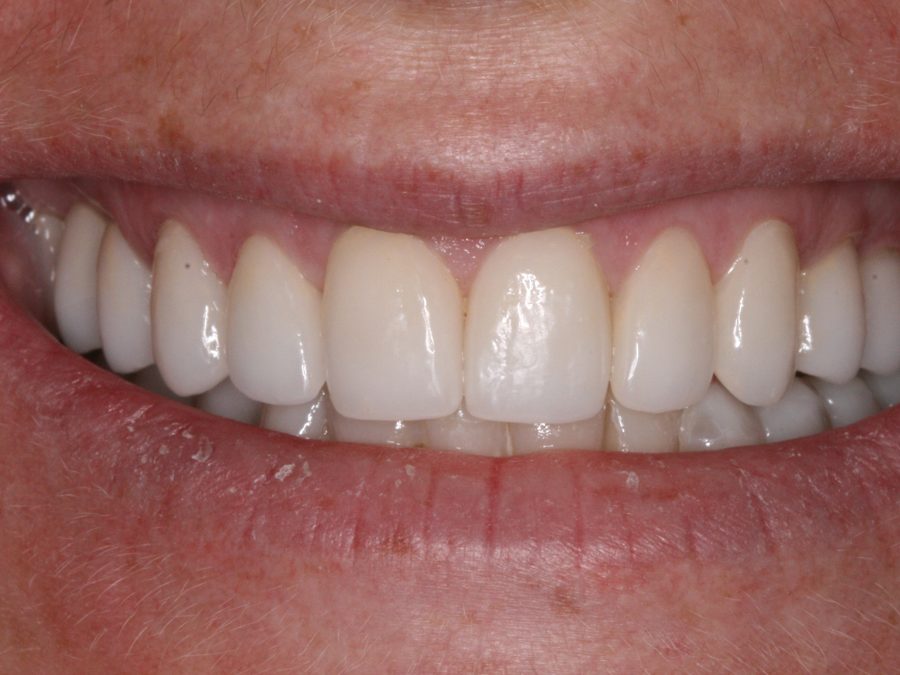 After same-day restoration