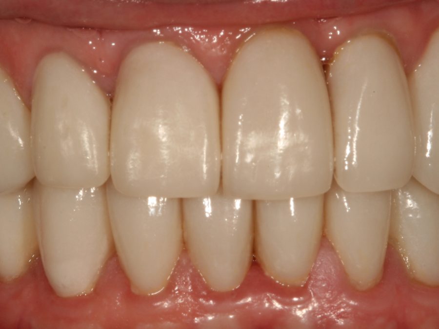 After same-day restoration