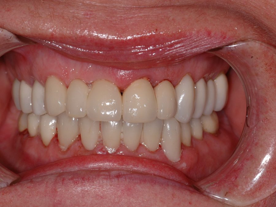 After same-day restoration