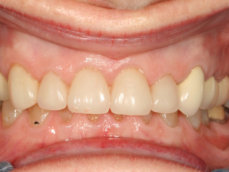 Before same-day restoration
