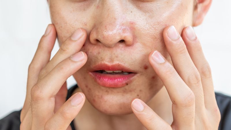 Da Dầu Là Gì? Đặc Điểm Và Cách Nhận Biết