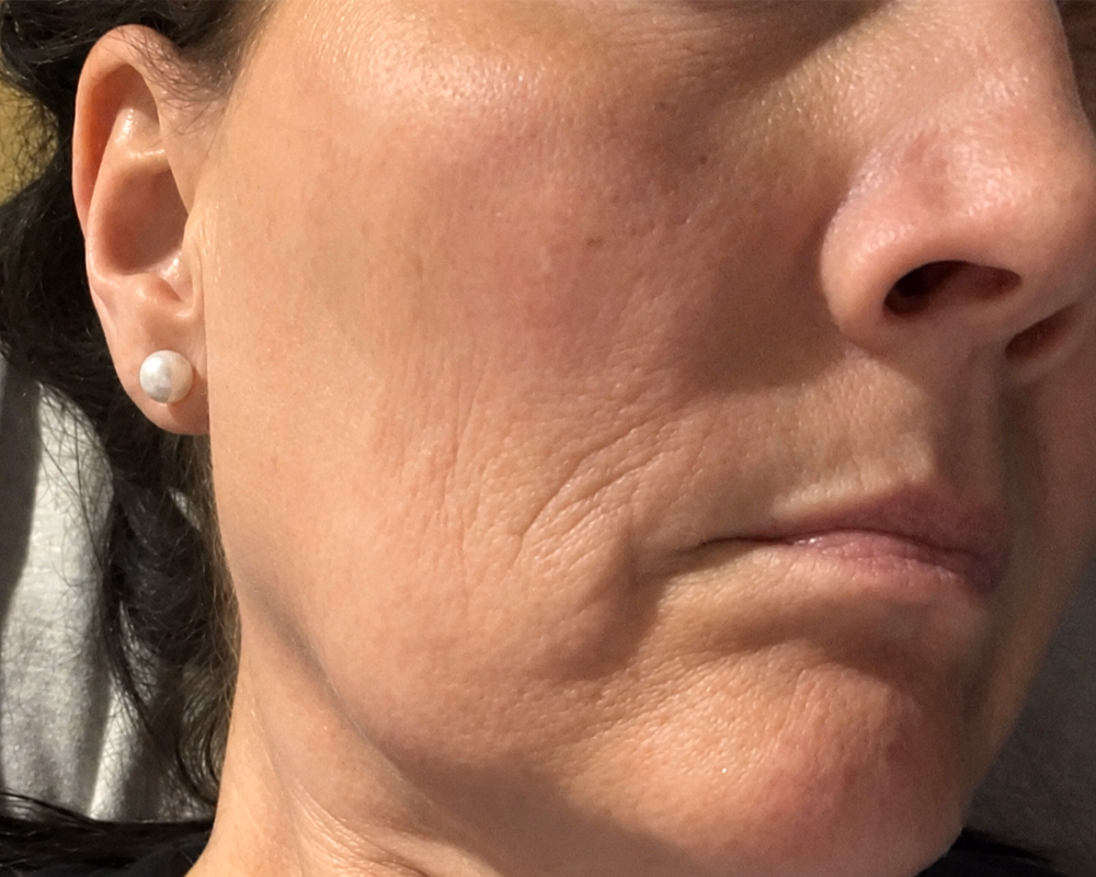 Close-up after photo showing facial skin appearance during a Raven Health personalized skincare journey in Canada.