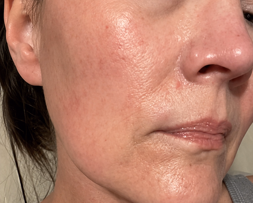 Close-up before photo showing facial skin texture prior to a Raven Health online skincare treatment in Canada.