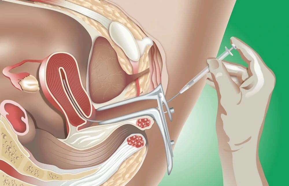 What is intrauterine insemination (IUI) and how does artificial insemination work?