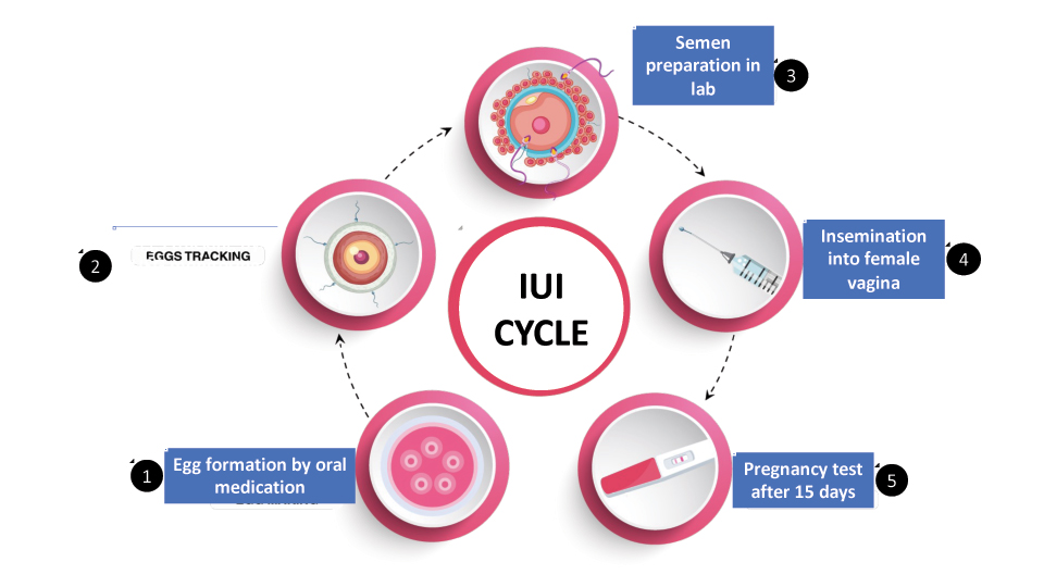 How many cycles of intrauterine insemination are recommended?