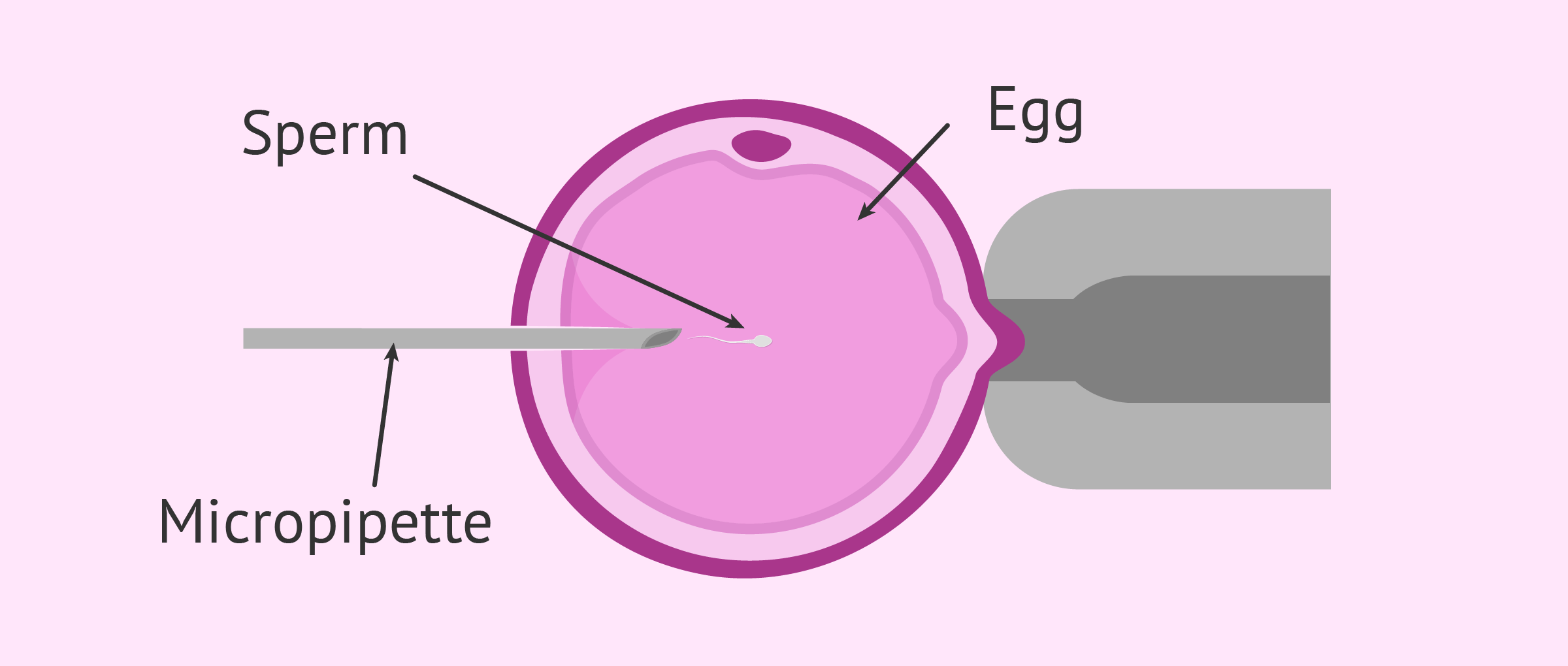 Intracytoplasmic Sperm Injection (ICSI): A Closer Look at This IVF Technique
