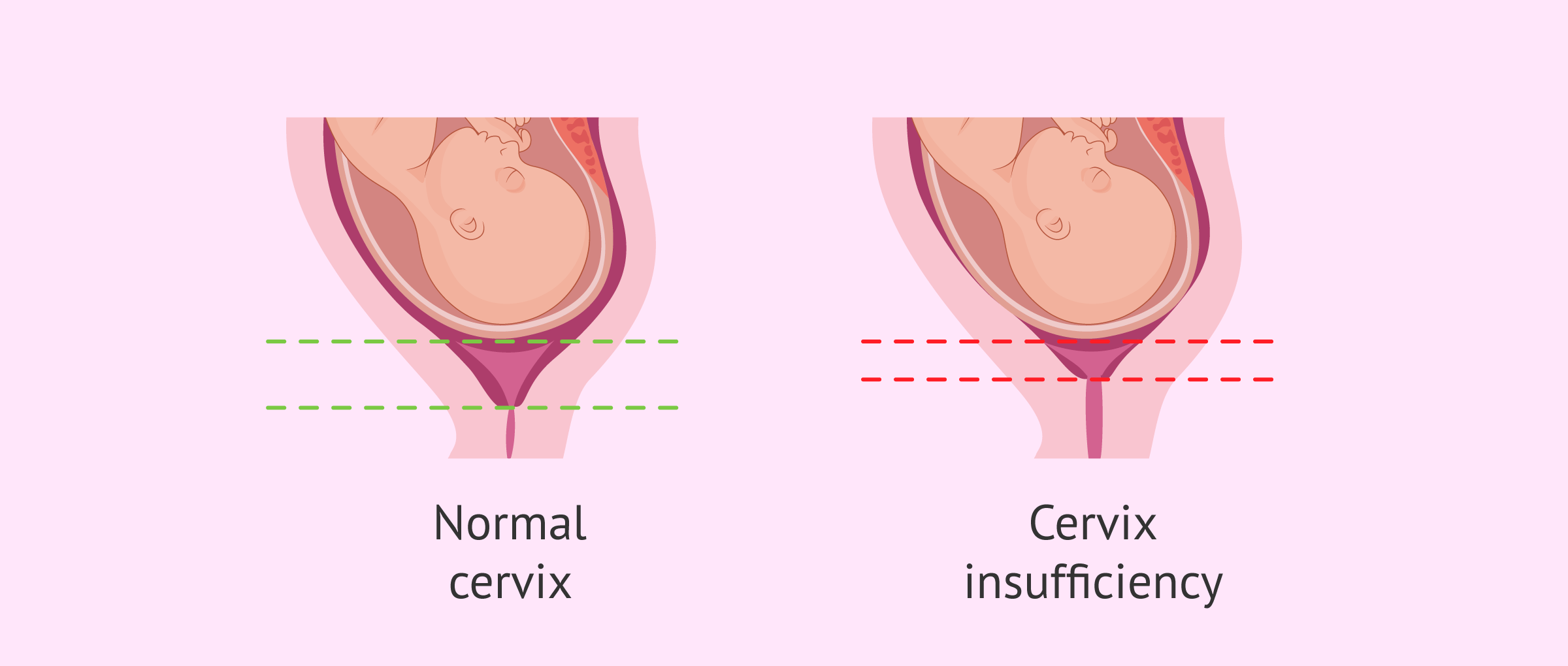 What is an Incompetent Cervix (Cervical Insufficiency or Cervical Incompetence)?