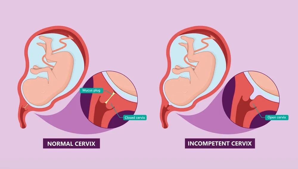 Understanding Cervical Weakness: Anatomy and Function of the Cervix