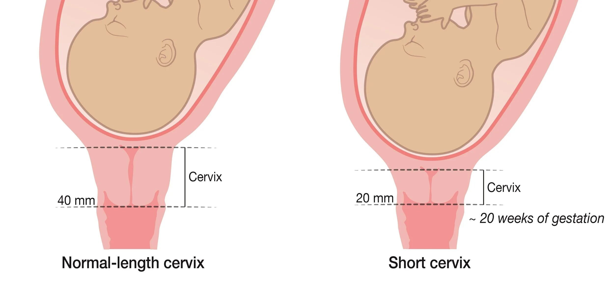 10 Risk Factors for Incompetent Cervix and Cervical Insufficiency