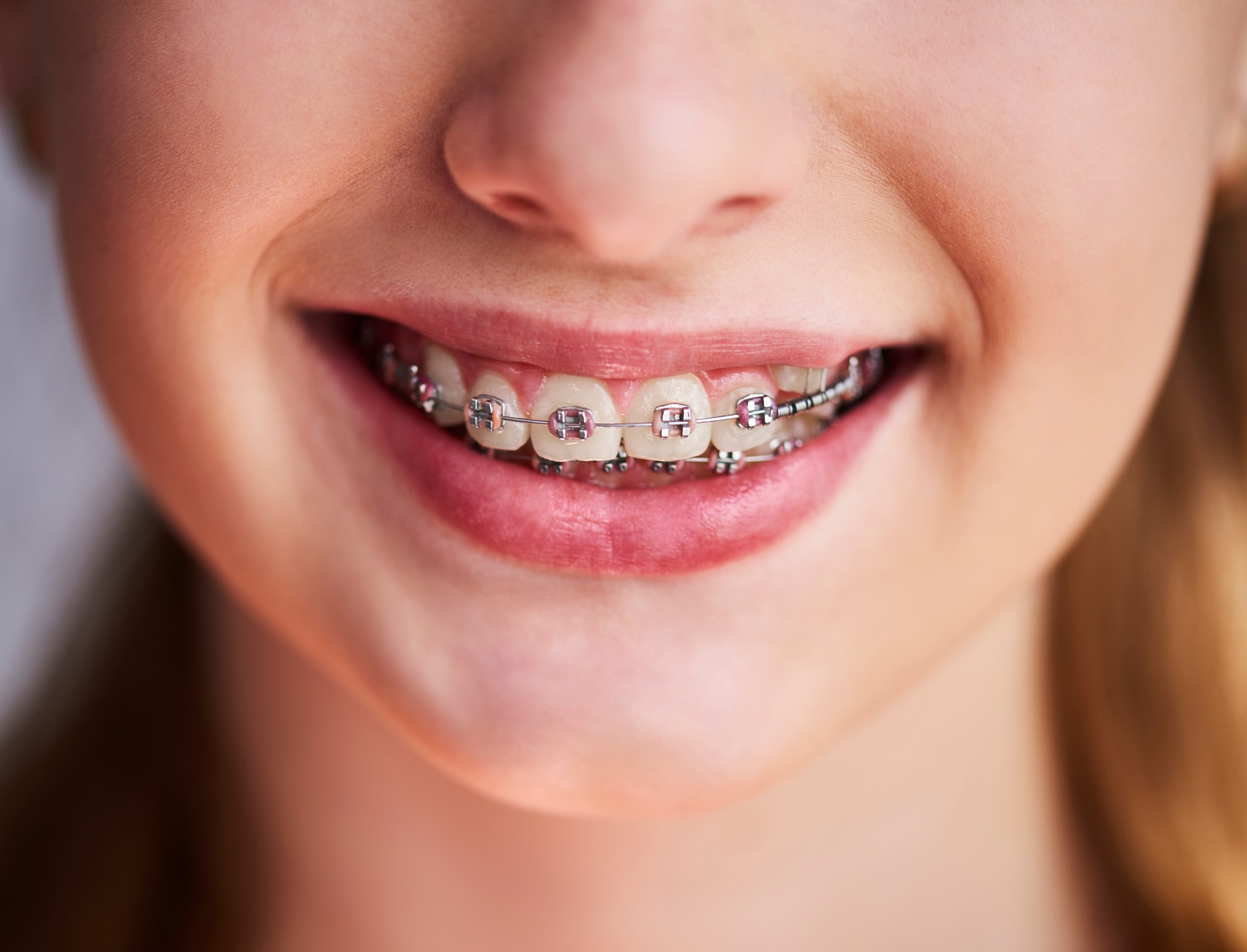 Braces in Overland Park