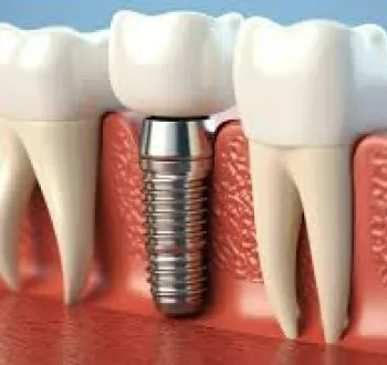 A dental implant with a screw in the middle of it.