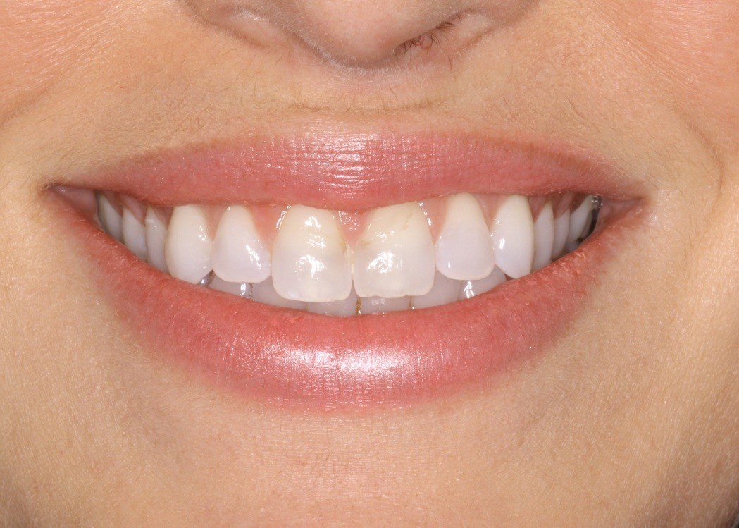 Before Image