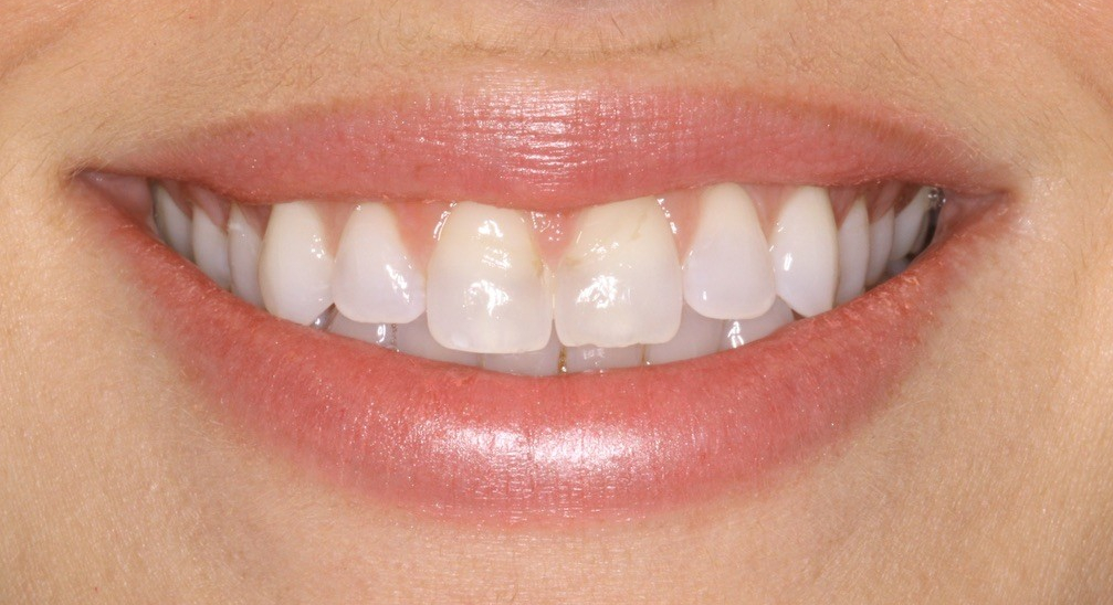 Before Image