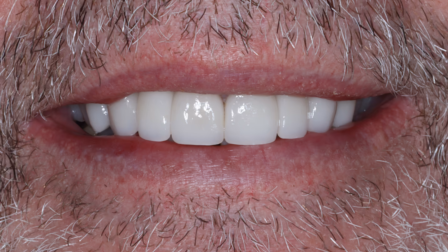 After Image