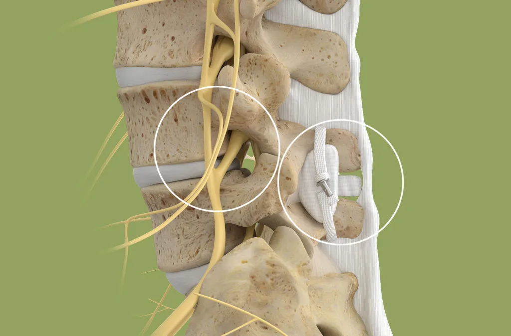 Medical illustration of lumbar spine showing vertebrae, nerves, implant, and soft tissue.