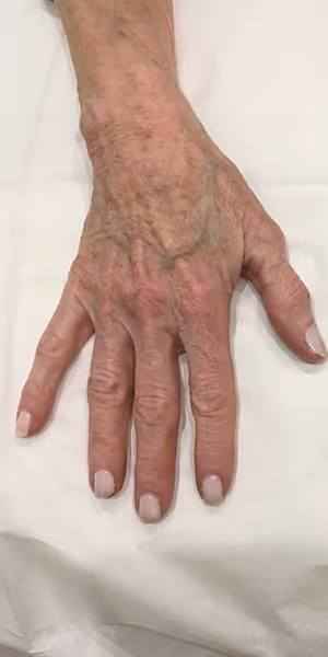 The back of a woman’s right hand before dermal filler