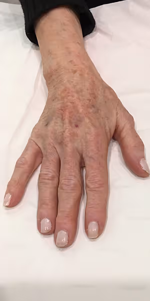 The back of a woman’s right hand after dermal filler