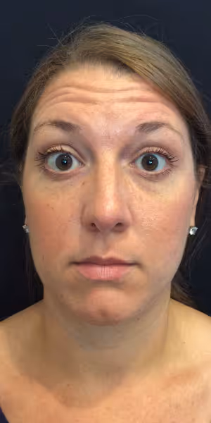 A woman's face before Botox treatments