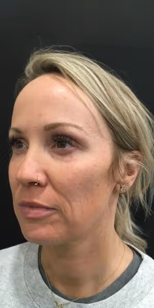 One side of a woman's face before Dysport and Sculptra treatments