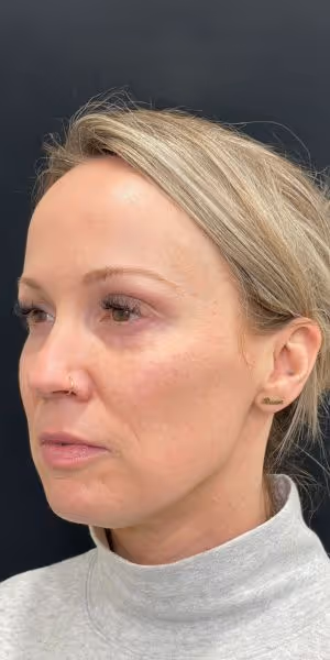 One side of a woman's face after Dysport and Sculptra treatments