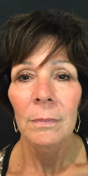 A woman’s face before lip filler and dermal filler treatments.