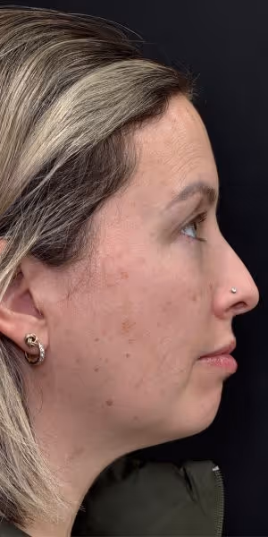 The side profile of a woman’s face before dermal filler.