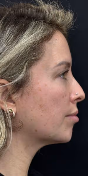 The side profile of a woman’s face after dermal filler.