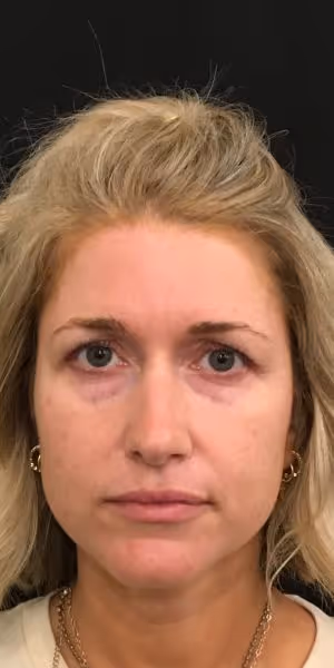 A woman's face before lip filler, Dysport, dermal filler, and Sculptra