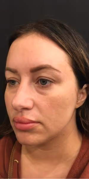 One side of a woman's face before Botox treatmentsOne side of a woman's face before dermal filler, Sculptra, Botox, and Dysport treatments.