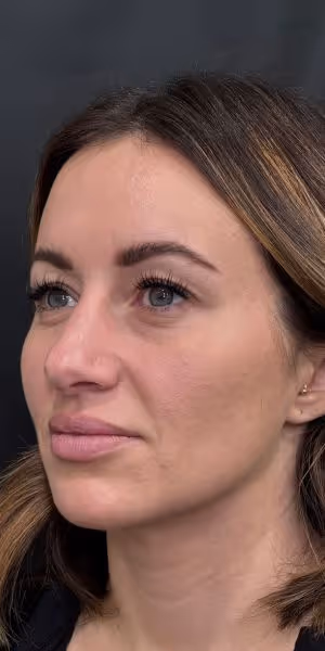 One side of a woman’s face after Botox treatments