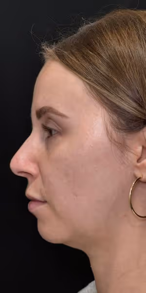 A woman’s side profile before lip filler and dermal filler treatments.