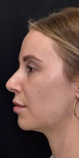 A woman’s side profile before lip filler and dermal filler treatments