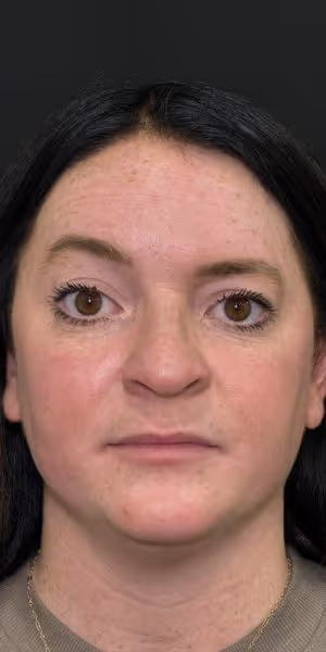 A woman's face before Dysport and medical-grade skincare.