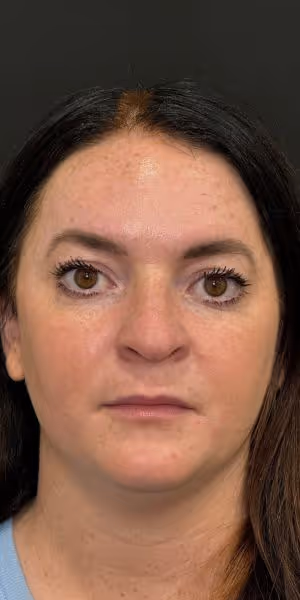 A woman’s face after Dysport and medical-grade skincare.