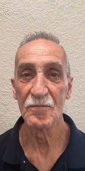 Headshot of a man before Dysport and dermal filler