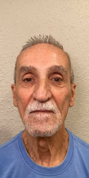 Headshot of a man after Dysport and dermal filler