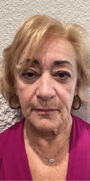 A woman’s face before dermal filler