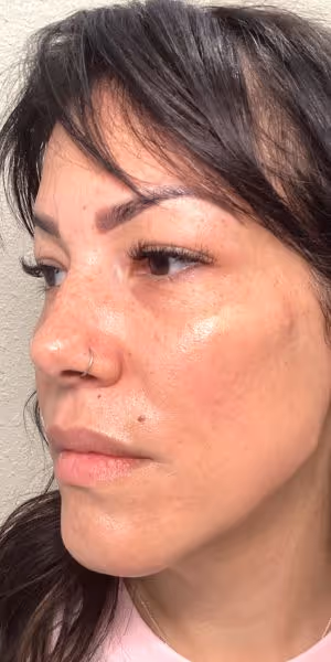 One side of the face of a woman wearing a nose-ring after dermal filler