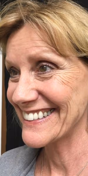 One side of a smiling woman's face with forehead wrinkles and crow’s feet before Botox treatments