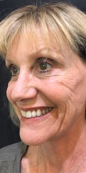 One side of a smiling woman's face after Botox treatments without forehead wrinkles and crow’s feet