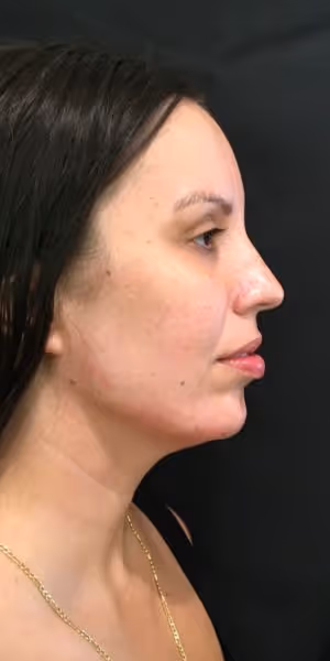 Side profile of a woman after dermal filler