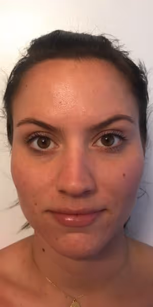 A woman’s face after Dysport treatment without forehead wrinkles