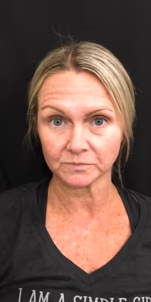 Headshot of a woman before Botox