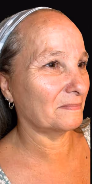 Three-quarter shot of a woman’s face before dermal filler.