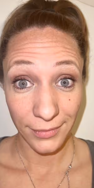 A woman's face with forehead wrinkles before Botox treatment