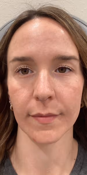 A woman’s face after dermal filler, lip filler, and Dysport treatments.