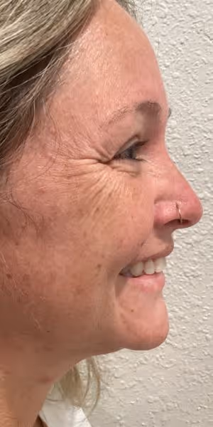 A woman’s side profile with crow’s feet before Dysport treatment